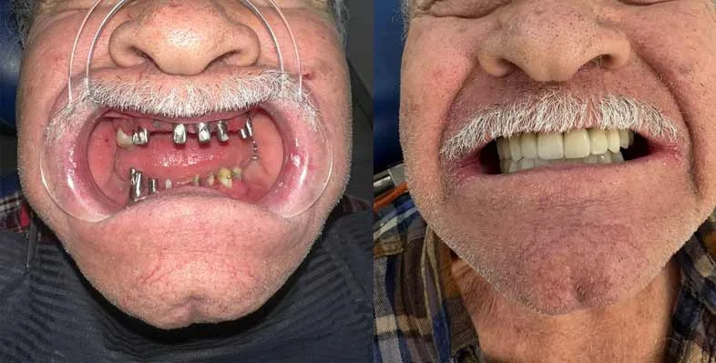 Before & after — Smile rehabilitation
