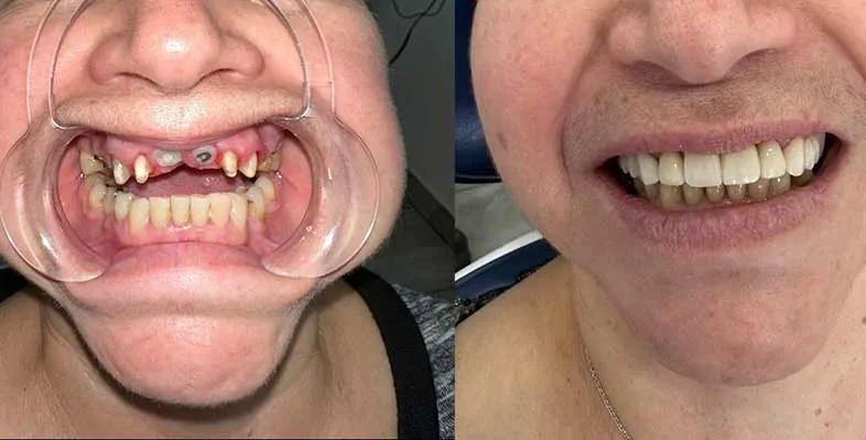Before & after — Smile rehabilitation