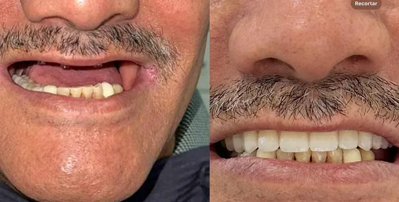 Before & after — Smile rehabilitation
