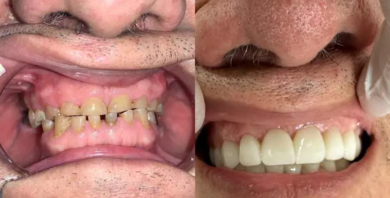 Before & after — Smile rehabilitation