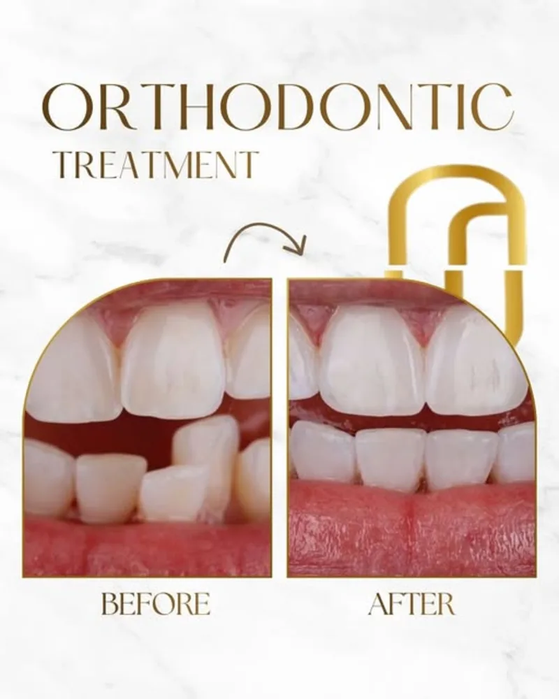 Orthodontic treatment